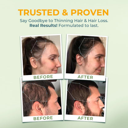 Vital Hair Complex – Biotin &amp; Vitamin B Hair Vitamins for Women &amp; Men